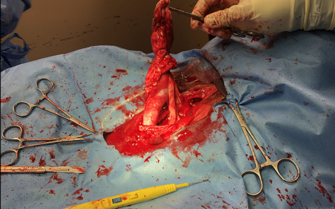 Umbilical hernia