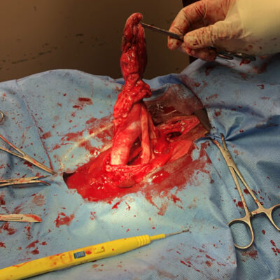 Umbilical hernia