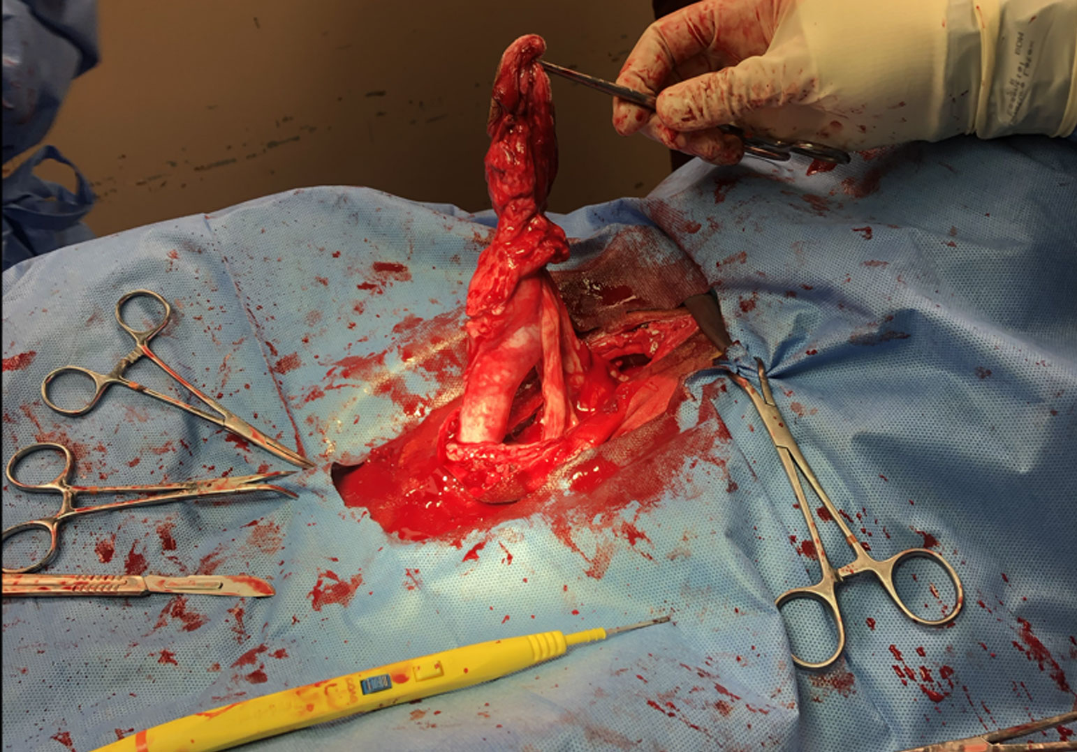 Umbilical hernia